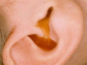 Lỗ tai bị chảy mủ là biểu hiện của một số bệnh nguy hiểm