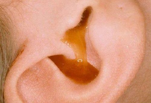 Lỗ tai bị chảy mủ phải làm sao? Cách phòng bị và điều trị hiệu quả