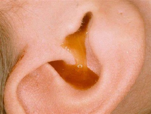 Lỗ tai bị chảy mủ phải làm sao? Cách phòng bị và điều trị hiệu quả